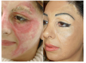 basma-hameed-before-after-cosmetic-tattoo